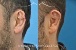 Photo of a patient before and after a procedure. Cauliflower Ear Deformity Repair