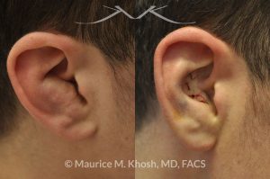 Photo of a patient before and after a procedure. Ear Hematoma (Blood Clot) Drainage