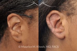 Photo of a patient before and after a procedure. Ear Reconstruction To Repair The Helical Rim After Traumatic-Injury