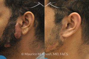 Photo of a patient before and after a procedure. Keloid