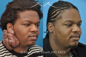 Photo of a patient before and after a procedure. Keloid Ear