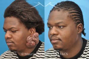 Photo of a patient before and after a procedure. Keloid Ear