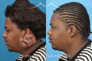 New York NY Doctor for Keloid Scar Surgery
