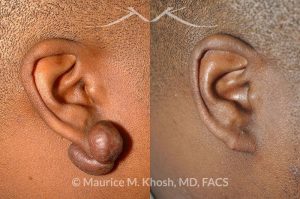 Photo of a patient before and after a procedure. Keloid Ear