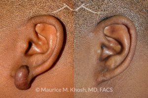 Photo of a patient before and after a procedure. Keloid Earlobe