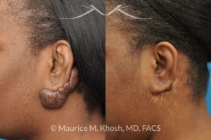 Photo of a patient before and after a procedure. Keloid Earlobe