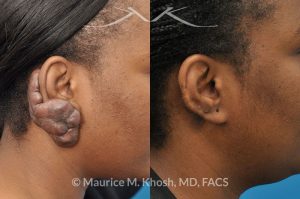 Photo of a patient before and after a procedure. Keloid Earlobe
