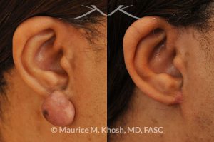 Photo of a patient before and after a procedure. Keloid Earlobe