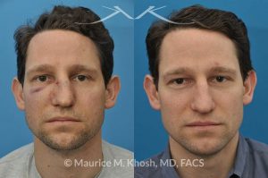 Photo of a patient before and after a procedure. Nose Fracture