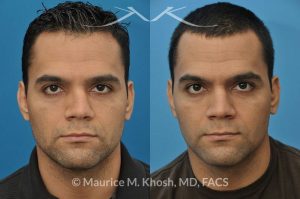 Photo of a patient before and after a procedure. Nose Fracture