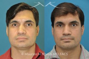 Photo of a patient before and after a procedure. Nose Fracture