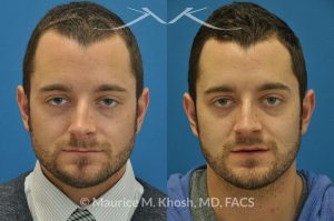 Photo of a patient before and after a procedure. Nose Fracture