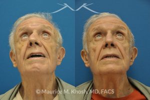 Photo of a patient before and after a procedure. Nose Fracture