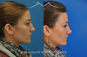 Photo of a patient before and after a procedure. Nose Fracture