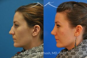 Photo of a patient before and after a procedure. Nose Fracture