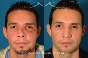 Photo of a patient before and after a procedure. Nose Fracture