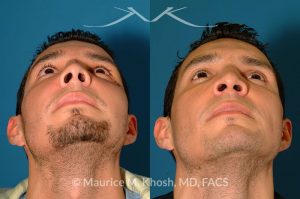 Photo of a patient before and after a procedure. Nose Fracture