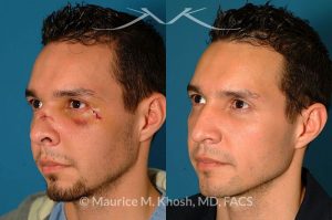 Photo of a patient before and after a procedure. Nose Fracture