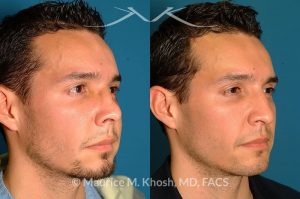 Photo of a patient before and after a procedure. Nose Fracture