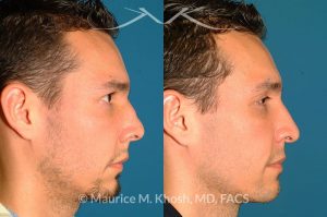 Photo of a patient before and after a procedure. Nose Fracture