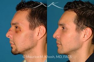 Photo of a patient before and after a procedure. Nose Fracture