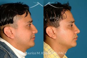 Photo of a patient before and after a procedure. Nose Fracture