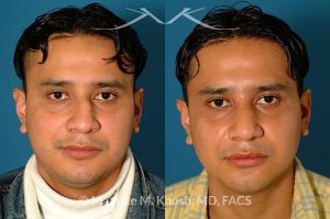 Photo of a patient before and after a procedure. Nose Fracture