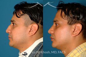 Photo of a patient before and after a procedure. Nose Fracture