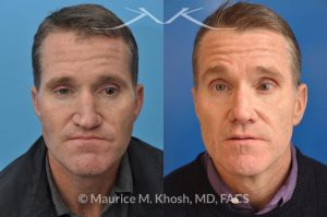 Photo of a patient before and after a procedure. Revision rhinoplasty utilizing rib cartilage - This gentleman who had previously undergone rhinoplasty complained of droopy tip, nose obstruction, and asymmetric appearance of the tip. Revision rhinoplasty utilizing rib cartilage, performed through the open approach allowed restoration of the nasal tip symmetry, improved breathing, and normal tip position.