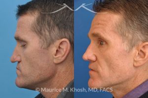 Photo of a patient before and after a procedure. Revision rhinoplasty utilizing rib cartilage - This gentleman who had previously undergone rhinoplasty complained of droopy tip, nose obstruction, and asymmetric appearance of the tip. Revision rhinoplasty utilizing rib cartilage, performed through the open approach allowed restoration of the nasal tip symmetry, improved breathing, and normal tip position.