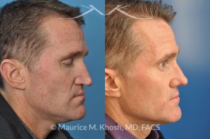 Photo of a patient before and after a procedure. This gentleman who had previously undergone rhinoplasty complained of droopy tip, nose obstruction, and asymmetric appearance of the tip. Revision rhinoplasty utilizing rib cartilage, performed through the open approach allowed restoration of the nasal tip symmetry, improved breathing, and normal tip position.