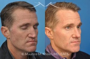 Photo of a patient before and after a procedure. Revision rhinoplasty utilizing rib cartilage - This gentleman who had previously undergone rhinoplasty complained of droopy tip, nose obstruction, and asymmetric appearance of the tip. Revision rhinoplasty utilizing rib cartilage, performed through the open approach allowed restoration of the nasal tip symmetry, improved breathing, and normal tip position.