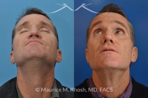 Photo of a patient before and after a procedure. This gentleman who had previously undergone rhinoplasty complained of droopy tip, nose obstruction, and asymmetric appearance of the tip. Revision rhinoplasty utilizing rib cartilage, performed through the open approach allowed restoration of the nasal tip symmetry, improved breathing, and normal tip position.