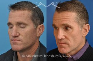 Photo of a patient before and after a procedure. Revision rhinoplasty utilizing rib cartilage - This gentleman who had previously undergone rhinoplasty complained of droopy tip, nose obstruction, and asymmetric appearance of the tip. Revision rhinoplasty utilizing rib cartilage, performed through the open approach allowed restoration of the nasal tip symmetry, improved breathing, and normal tip position.
