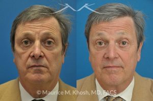 Photo of a patient before and after a procedure. Revision open approach rhinoplasty with septum cartilage graft - Previous rhinoplasty in this gentleman had caused nasal obstruction, pinched and retracted nostrils, and excess columellar show. Revision open approach rhinoplasty with septum cartilage graft allowed restoration of breathing, and creation of a natural and harmonious appearing nose.