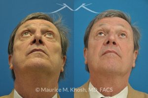 Photo of a patient before and after a procedure. Revision open approach rhinoplasty with septum cartilage graft - Previous rhinoplasty in this gentleman had caused nasal obstruction, pinched and retracted nostrils, and excess columellar show. Revision open approach rhinoplasty with septum cartilage graft allowed restoration of breathing, and creation of a natural and harmonious appearing nose.