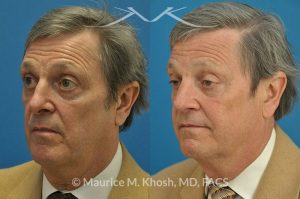 Photo of a patient before and after a procedure. Revision open approach rhinoplasty with septum cartilage graft - Previous rhinoplasty in this gentleman had caused nasal obstruction, pinched and retracted nostrils, and excess columellar show. Revision open approach rhinoplasty with septum cartilage graft allowed restoration of breathing, and creation of a natural and harmonious appearing nose.