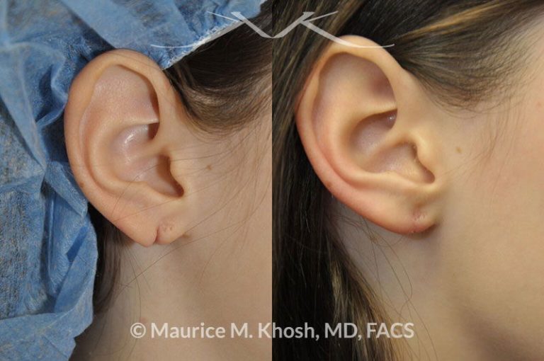 New York Torn Earlobe Repair Maurice M. Khosh MD, FACS