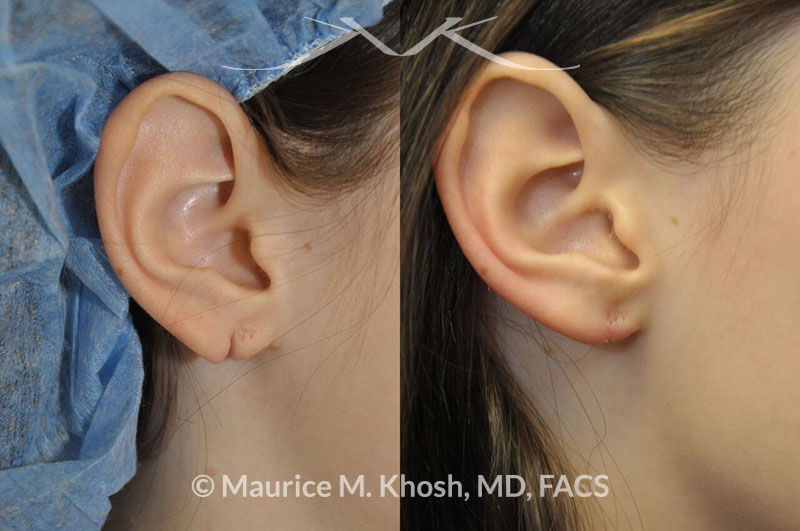 Tribal Earlobe Corrective Surgery UK, Split Earlobe Repair London, Ripped  Earlobes