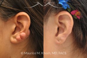 Photo of a patient before and after a procedure. Keloid Ear