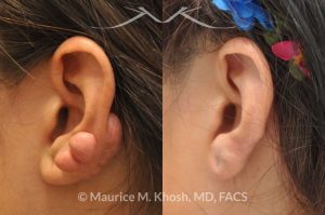 Photo of a patient before and after a procedure. Keloid Ear