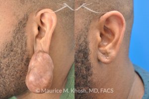 Photo of a patient before and after a procedure. Large keloid of ear