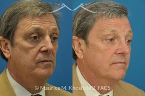 Photo of a patient before and after a procedure. Revision open approach rhinoplasty with septum cartilage graft - Previous rhinoplasty in this gentleman had caused nasal obstruction, pinched and retracted nostrils, and excess columellar show. Revision open approach rhinoplasty with septum cartilage graft allowed restoration of breathing, and creation of a natural and harmonious appearing nose.