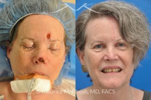 Photo of a patient before and after a procedure. Moh's skin cancer reconstruction
