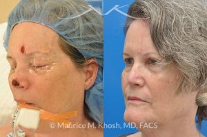 Photo of a patient before and after a procedure. Moh's skin cancer reconstruction