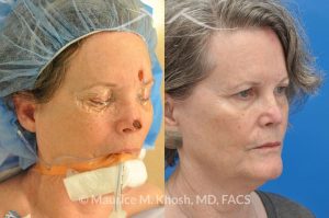 Photo of a patient before and after a procedure. Moh's skin cancer reconstruction