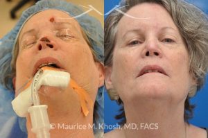 Photo of a patient before and after a procedure. Moh's skin cancer reconstruction