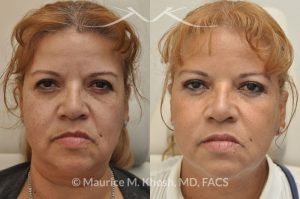 Photo of a patient before and after a procedure. Botox for frown lines, Restylane filler injection of the cheeks