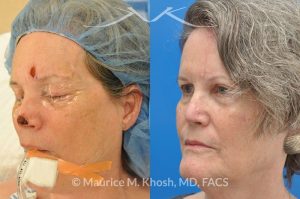 Photo of a patient before and after a procedure. Mohs reconstruction of forehead