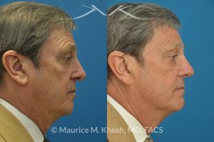 Photo of a patient before and after a procedure. Revision open approach rhinoplasty with septum cartilage graft - Previous rhinoplasty in this gentleman had caused nasal obstruction, pinched and retracted nostrils, and excess columellar show. Revision open approach rhinoplasty with septum cartilage graft allowed restoration of breathing, and creation of a natural and harmonious appearing nose.